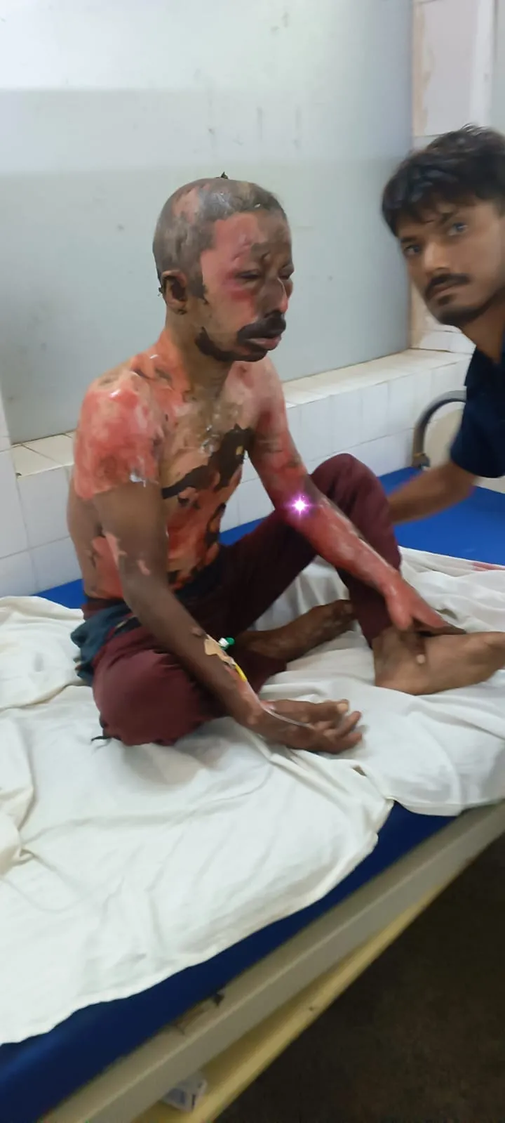 खानपुर बेलहरी केड़वा में घरेलू विवाद के बाद व्यक्ति ने खुद पर पेट्रोल डालकर आग लगाई, हालत गंभीर